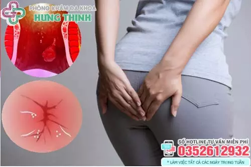 Ngứa hậu môn có phải bị trĩ không?