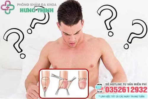 Chi phí cắt bao quy đầu ở Hà Nội