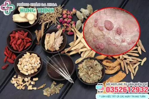 Chữa sùi mào gà bằng thuốc đông y