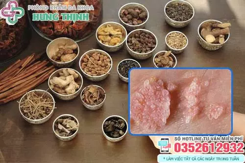 Chữa sùi mào gà bằng Đông y