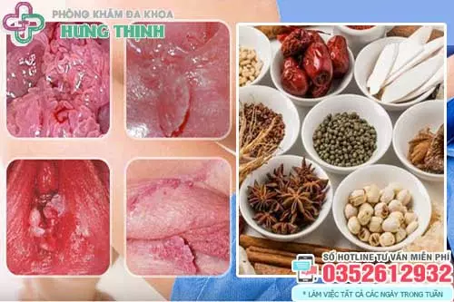 Có nên chữa sùi mào gà bằng thuốc Đông y?