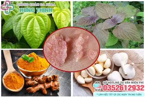 Cách chữa sùi mào gà bằng thuốc nam