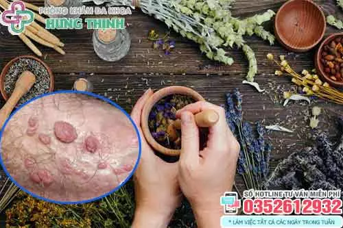 Chữa sùi mào gà bằng thuốc nam