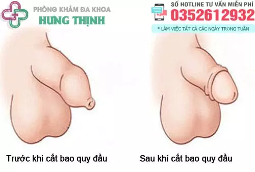 Cắt bao quy đầu bao lâu thì lành thương