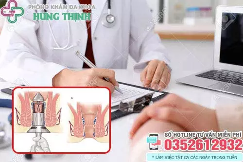 Bệnh trĩ có chữa khỏi dứt điểm được không?