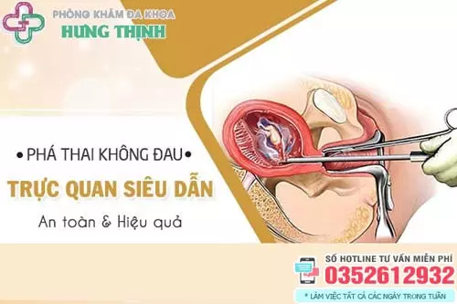 Phá thai không đau trực quan bằng ống siêu dẫn