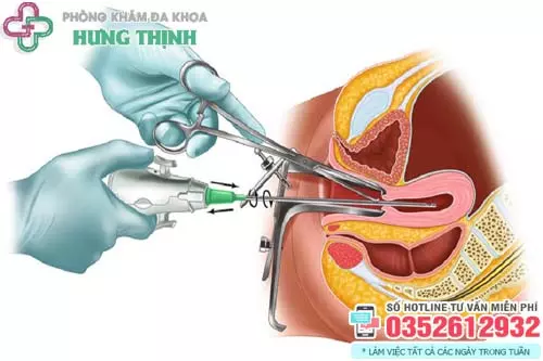 Hút thai chân không có đau không?
