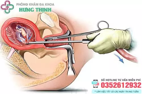 Quy trình hút thai chân không