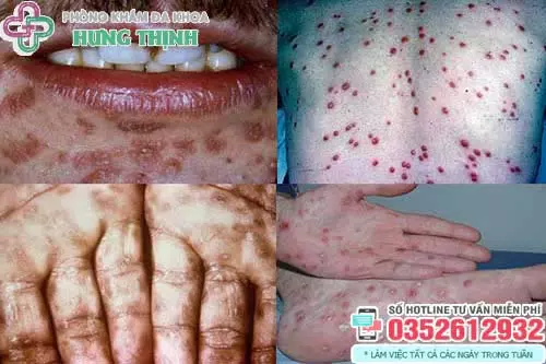 Thời gian ủ bệnh của giang mai