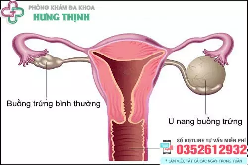 U nang buồng trứng có nguy hiểm không?
