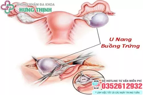 Mổ u nang buồng trứng