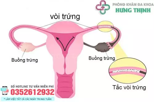 Tắc vòi trứng là gì?