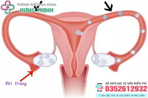 Cách chữa tắc vòi trứng