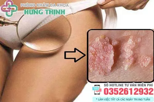 Hình ảnh cục thịt thừa ở vùng kín