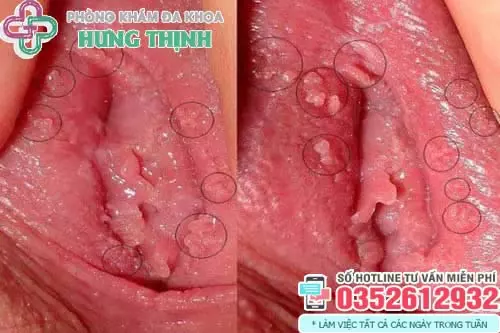 Hình ảnh cục thịt thừa ở vùng kín do sùi mào gà
