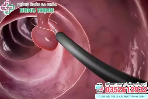 Hình ảnh cục thịt thừa ở vùng kín do polyp âm đạo