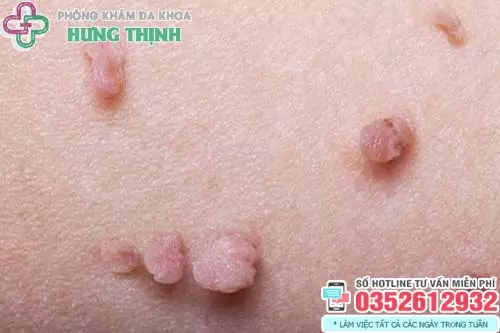 Hình ảnh cục thịt thừa ở vùng kín do sinh lý