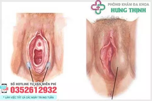 Hình ảnh cục thịt thừa ở vùng kín do u nang Bartholin