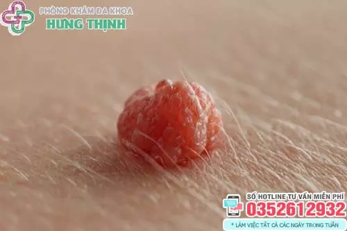 Hình ảnh cục thịt thừa ở ngoài vùng kín