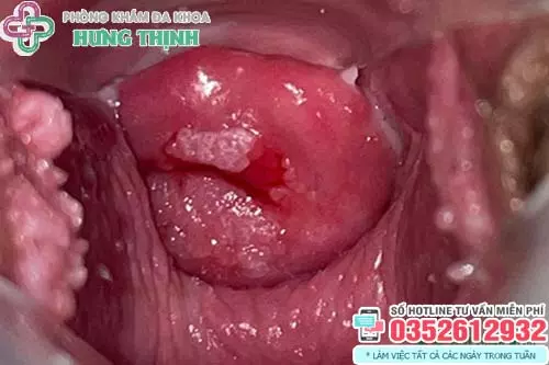 Hình ảnh sùi mào gà ở trong cổ tử cung
