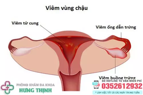 Bệnh viêm vùng chậu