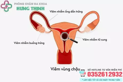 Hình ảnh viêm vùng chậu