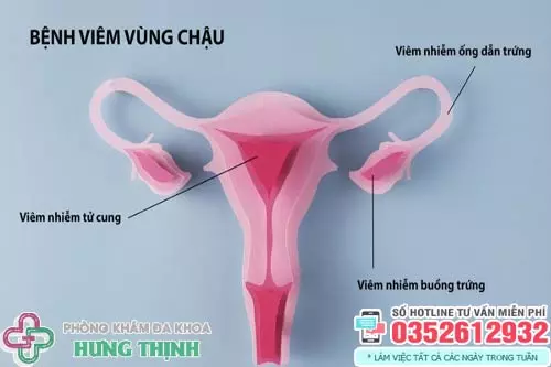 Hình ảnh bệnh viêm vùng chậu