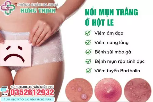 Hột le nổi mụn trắng, đỏ là bị làm sao?