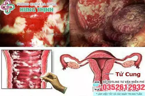 Vùng kín có mảng bám màu trắng