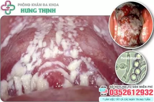 Bên trong vùng kín có mảng bám màu trắng cách khắc phục