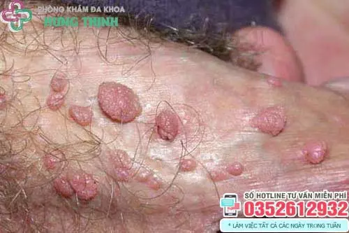 Tinh hoàn nổi mụn thịt