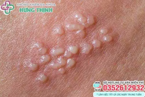 Nổi mụn nước ở tinh hoàn