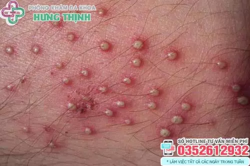 Tinh hoàn nổi mụn mủ