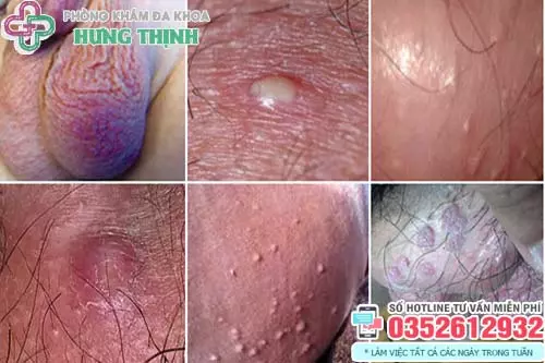 Nổi mụn ở tinh hoàn có sao không?