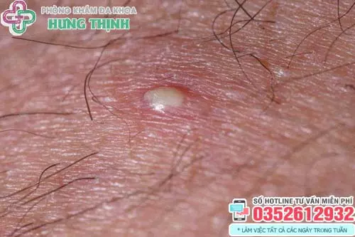 Cách trị mụn ở tinh hoàn