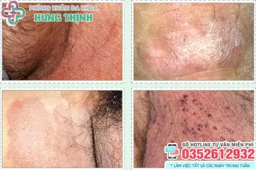 Hình ảnh ngứa bìu tinh hoàn