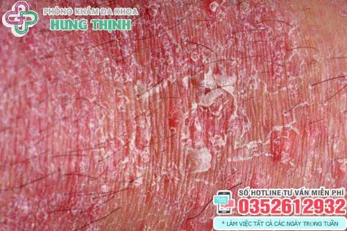 Hình ảnh ngứa bìu tróc vảy