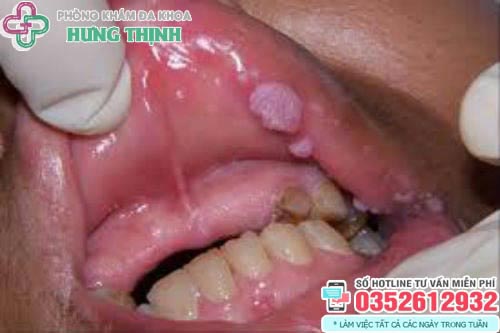 Hình ảnh bệnh sùi mào gà ở môi