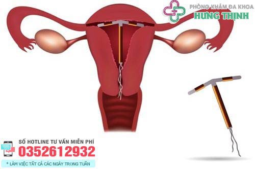 Đặt vòng tránh thai ở đâu