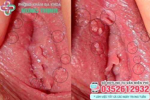 Hình ảnh mụn gai sinh dục ở nữ giới