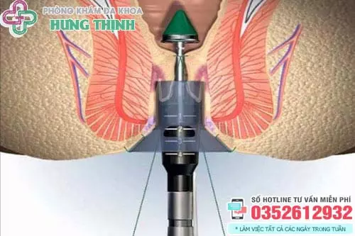 Cắt trĩ có gây mê không?
