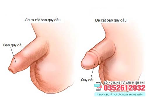 Hình ảnh trước và sau khi cắt bao quy đầu