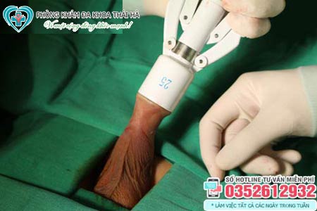 Hình ảnh cắt bao quy đầu bằng máy