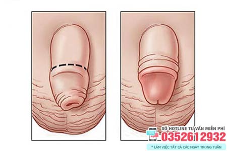 Hình ảnh cậu nhỏ sau khi cắt bao quy đầu bình thường