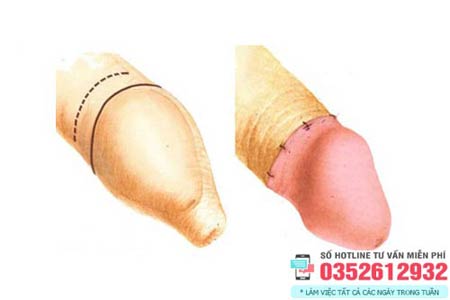 Hình ảnh trước và sau khi cắt bao quy đầu đã lành