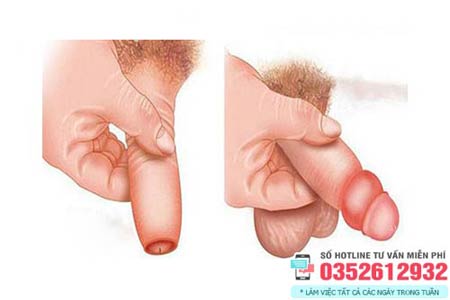 Hình ảnh sau khi cắt bao quy đầu bị phù nề