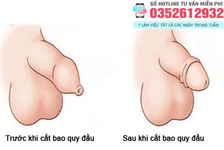 Hình ảnh chưa cắt bao quy đầu và sau khi cắt