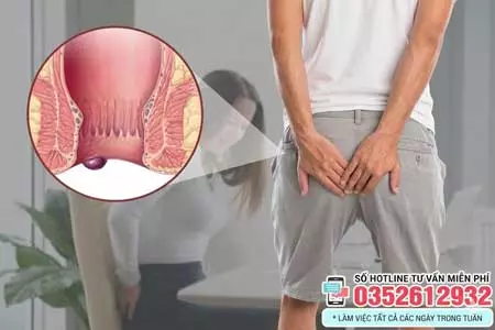 Dấu hiệu bệnh trĩ ngoại