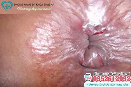 Hình ảnh trĩ ngoại độ 2