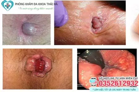 Hình ảnh trĩ ngoại độ 3